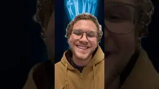 broken leg