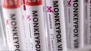 First probable Illinois case of monkeypox reported in Chicago