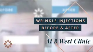 Vancouver Botox Injections at 8 West Clinic - Forehead & Frown Line Before & After Photos