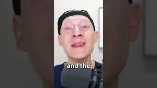 Why Get A Hair Transplant?