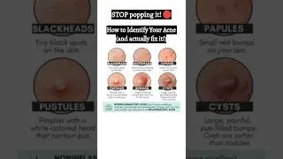 How to treat acne |types of acne and treatment #acne #acnetreatment #acnescars #skincare  #ytshorts