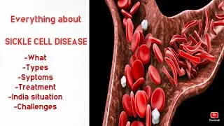 The Hindu Editorial Analysis- Sickle cell disease #UPSC#PCS #GS