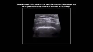 Full-thickness tear of the supraspinatus tendon on shoulder ultrasound (case 4)
