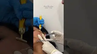 Botox for Face Slimming By Dr Anupriya Goel | Berkowits ✨