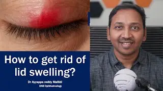 How to get rid of eye lid swelling fast | Dr Ayyappa reddy Mallidi