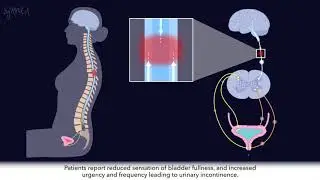 TESCoN: A noninvasive therapy for urinary incontinence