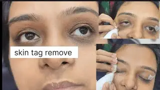 Beat Mole removal We offer laser mole removal Skin tag remove #skin tag remove#viral #skincare 