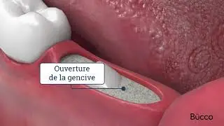 Dents de sagesse