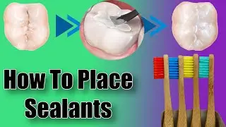 Dental Sealants - Prevent Cavities - Protective Tooth Paint
