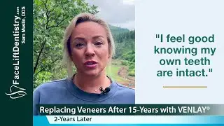 Replacing Veneers after 15 Years with Venlay - 2 Years Later