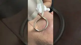 Portable co2 laser fractional stretch mark removal skin resurfacing scar removal