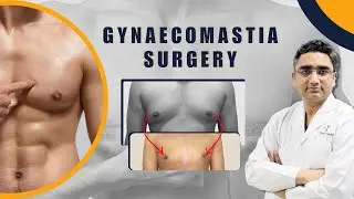 Grade 2 Gyno | Get Rid of Moobs | Can Gym Cure Gynecomastia? #gynecomastia