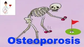 Board - Osteoporosis 1
