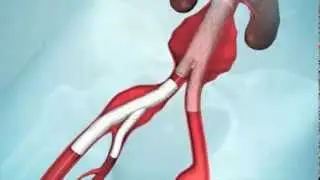 Intervencionismo Aórtico | Zenith Iliac Branch