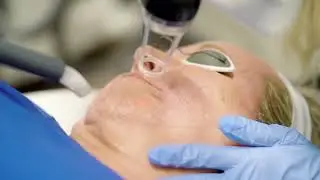 Skin Tightening with Morpheous 8