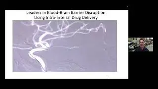Bypassing the blood brain barrier to improve the delivery of chemotherapeutics for brain tumors