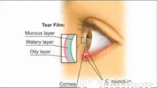 Heritage for The Blind - Preventing Dry Eye Syndrome