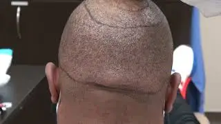 Fue hair transplant scar by Dr. Diep in San Francisco, Ca