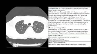 TB reactivation in an immunosuppressed renal transplant patient