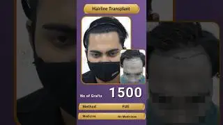 Reviving Your Hairline: Achieving Natural-Looking Results through Hairline Transplantation