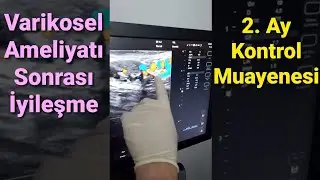 Varikosel Ameliyatı Sonrası İyileşme: 2. Ay Kontrol Muayenesi