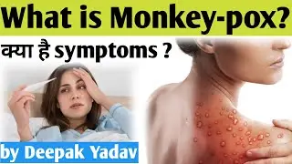 Monkeypox | symptoms of monkeypox | by Deepak Yadav