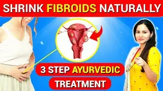 Shrink Fibroid Naturally 3 Step Ayurvedic Treatment | Fibroid Natural Cure | Uterine Fibroid Cure