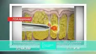 Cellulite Gone In 1 Treatment | Cellulaze | Chicago IL