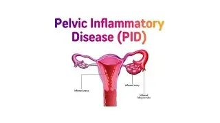 Menstrual cycle as related to Pelvic inflammatory disease