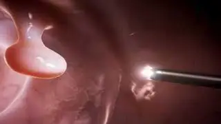 Polyps in Nose/ Uterus/Gallbladder - What to eat?