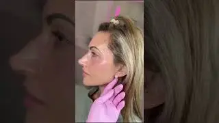 Jawline Contouring