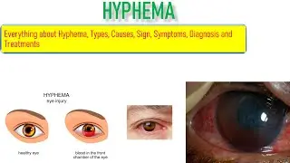 Hyphema- Sign, Symptoms, Causes, Risk factor and Treatment. Everything is covered in this video.