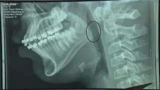 12-year-old boy swallows metal piece left from wire grill brush