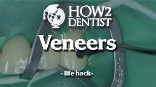 How to fix veneers / How to Dentist