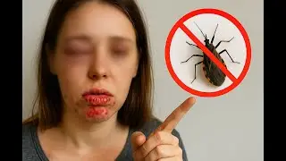 The Kissing Bugs: It sounds like a NICE name... But Its Bite Can Kill You! Chagas disease treatment