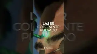 L&aacute;ser Colorante Pulsado ✨  #skincare #tratamientofacial #derma