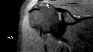 Labral tear and paralabral cyst.