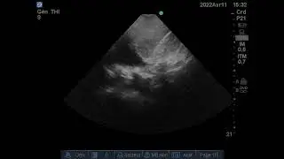 &Eacute;panchement pleural droit Rein Droit hyper&eacute;chogene et micro poly kystique &Eacute;chographie