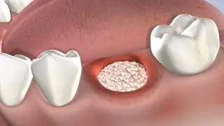 Socket Preservation in Springfield IL | Oral & Facial Surgeons of Illinois