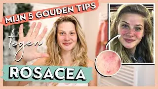HOE IK VAN ROSACEA AF KWAM | Mijn 5 gouden tips & behandelingen