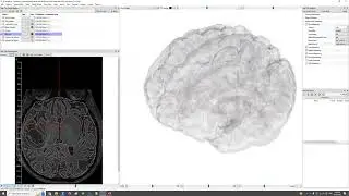 Automatic MRI brain tumor and tissue segmentation