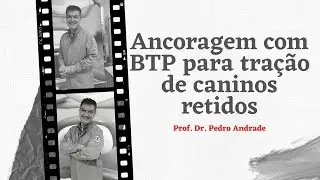 Ancoragem com BTP para tração de caninos retidos - Prof. Dr. Pedro Andrade Jr