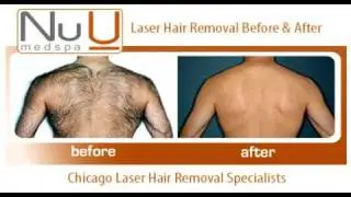 Chicago Laser Hair Removal - Before and Afters