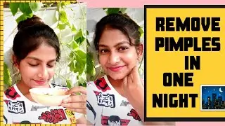 The ultimate solution to your acne problems/say bye bye to pimples in just one night