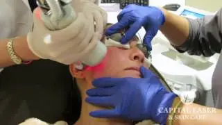 Halo Hybrid Fractional Laser Treatment with Dr. Elizabeth Tanzi
