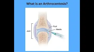 Joint aspiration to relieve pressure or arthrocentesis;  removing excess fluid procedure