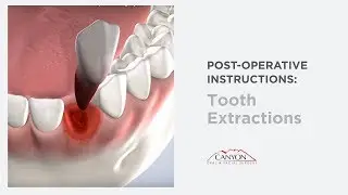 After Extraction Instructions in Las Vegas, NV