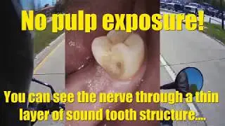 What is an Indirect Pulp Cap?