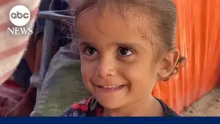 Gaza's silent crisis: A child's battle against malnutrition