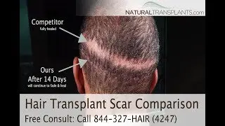 Hair Transplant: Bethesda, Maryland Hair Doctors | Get a Great Hair Transplant in Bethesda!